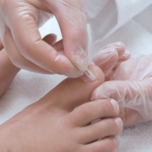 Voorbeeld van een nagelbeugel op een teennagel