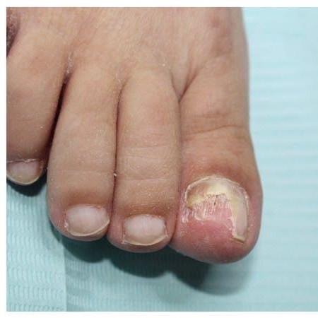 Voorbeeld 2 van een Mycose-behandeling bij Pedicure Halsteren